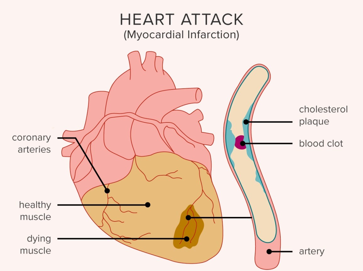 treatment for heart attack
